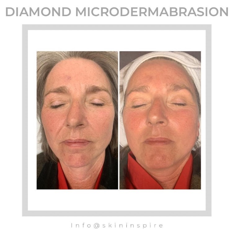 before and after microdermabrasion